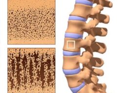 Rahasia Mengejutkan untuk Mencegah Osteoporosis