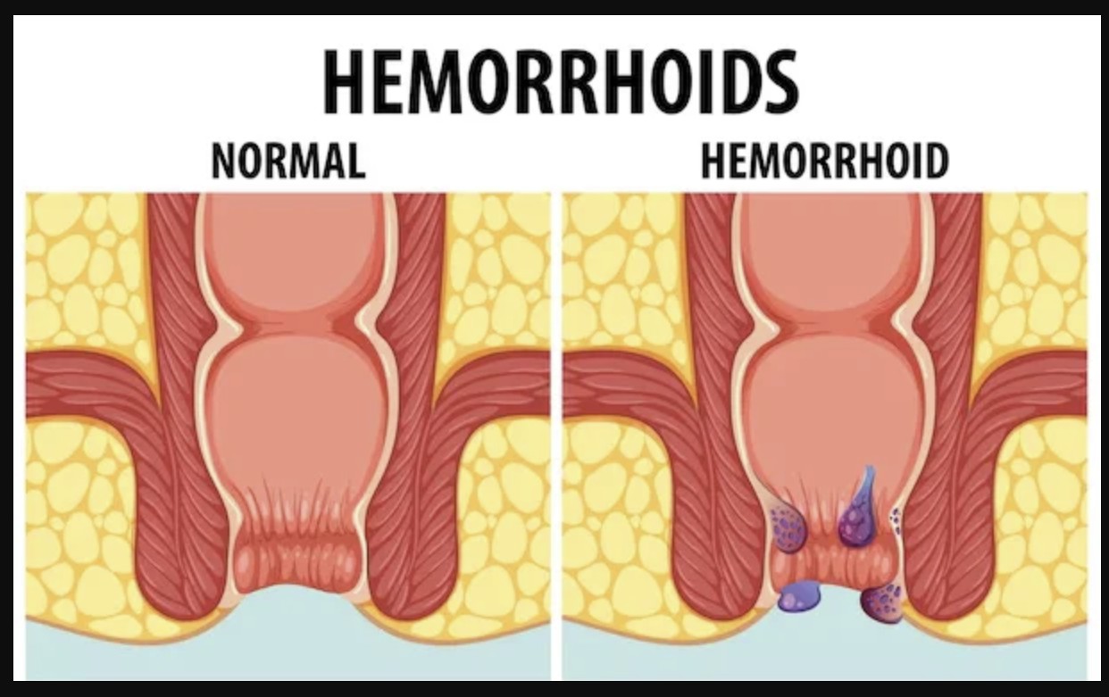 Workshop Expert Over Expense : Haemorrhoid Treatment Option, Optimalkan Peran Apoteker Beri Edukasi dan Rekomendasi